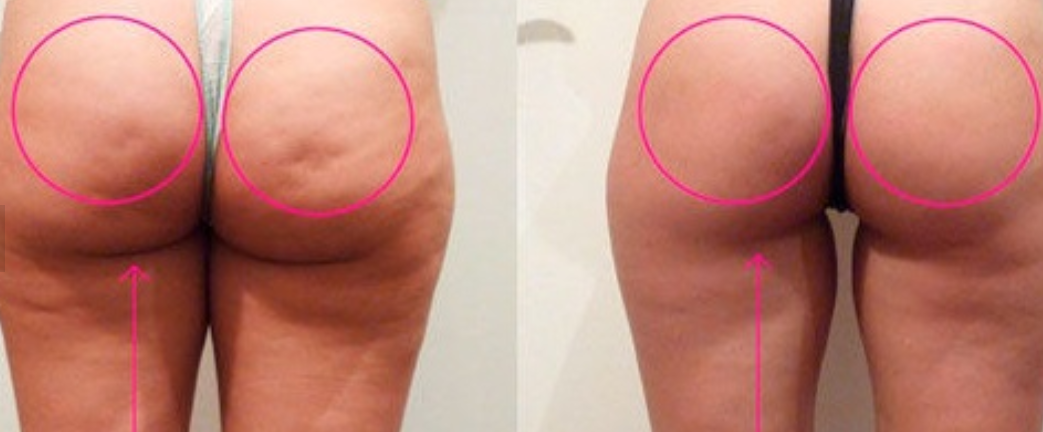Fat & Cellulite 10.18.19.png