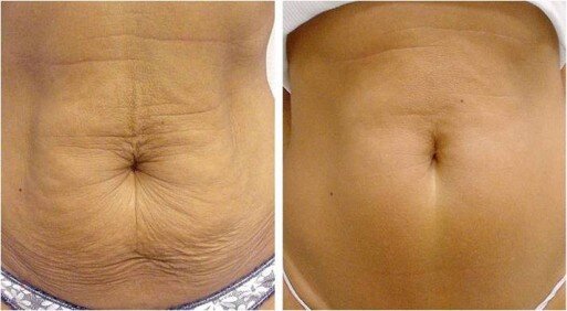 Affordable Coolsculpting And Sculpsure Treatment In Aurora