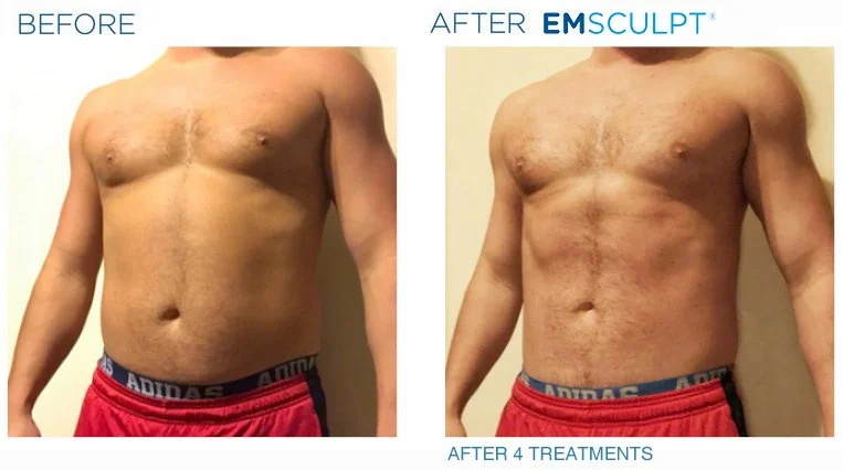 emsculpt before after man.jpeg