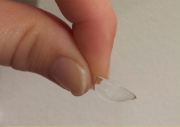 What is a scleral lens? Large diameter (12.5-25 mm) gas permeable contact lens Intended to rest on the sclera, bridging over the cornea