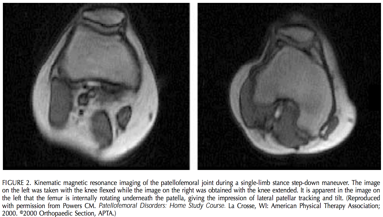 This image was taken from an article published by Chris Powers, PhD, PT, JOSPT 2003