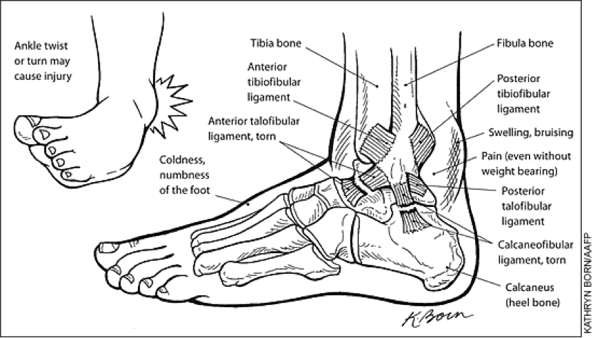 The two most commonly injured lateral ankle ligaments are the anterior talofibular ligament and the calcaneofibular ligament, pictured above. 