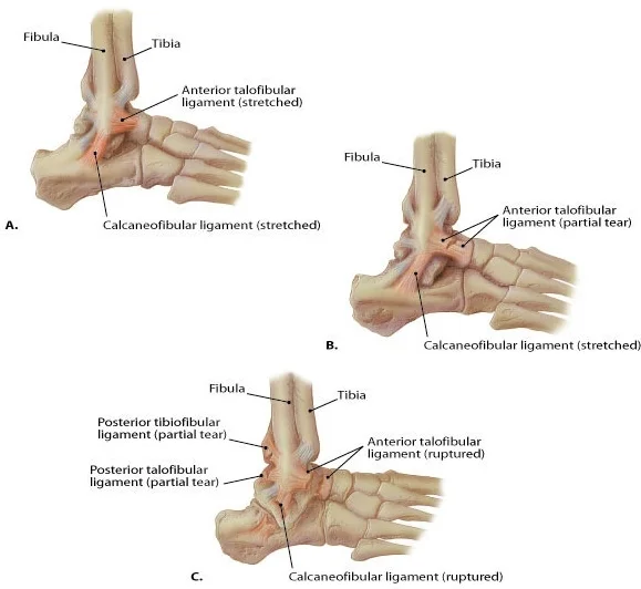 Detailed images of ATF and CF ligaments at the lateral ankle. 