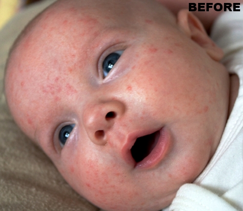 Baby Blemish - Before