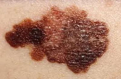Melanoma