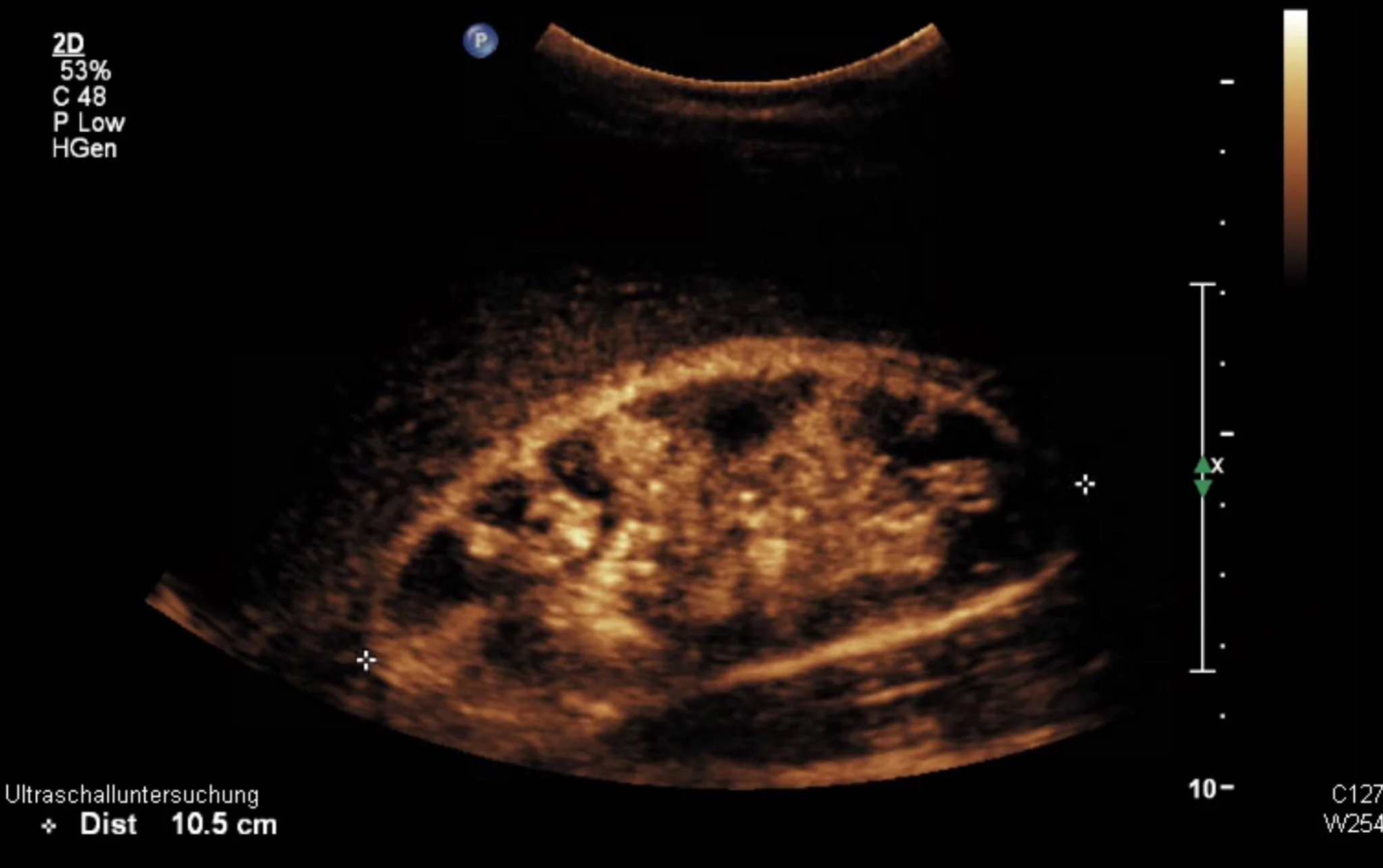 Renal Ultrasound - Cortical Nephrocalcinosis