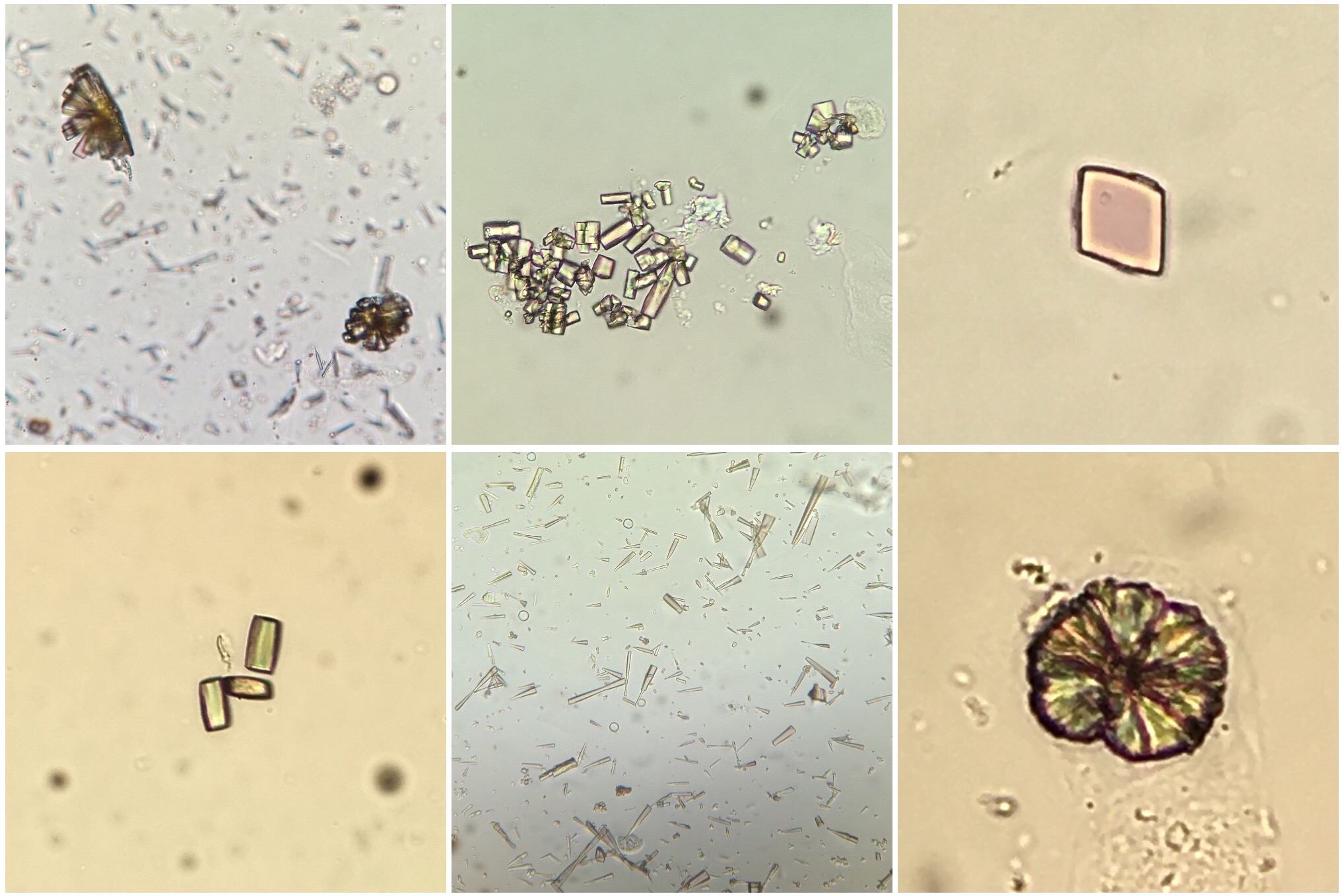 What does it mean to have amorphous crystals in urine Identifying Crystals In The Urinary Sediment Swissnephro