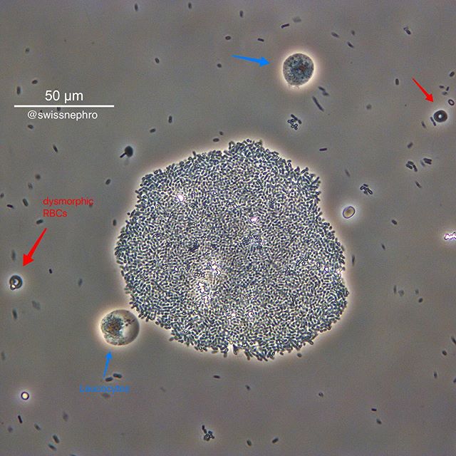 🔬A huge chunk of bacteria with some leucocytes and dysmorphic RBCs.
(Phase contrast, original magnification x400)
#urinarysediment #urine #nephrology #nephpearls #kidney #renal #FOAMed #medicine #microscope #laboratory #medstudent #pathology
