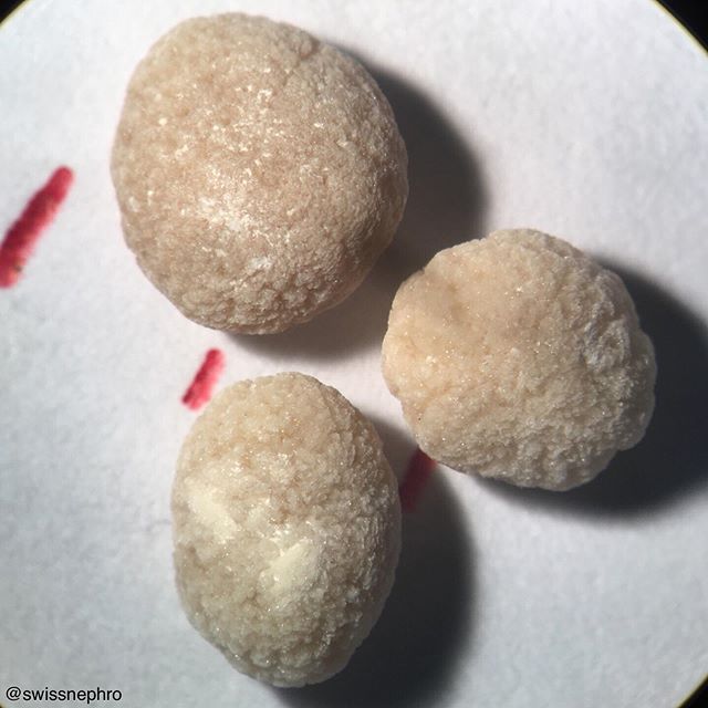 🔬Kidney stones composed of mostly brushite (CaHydrogenphosphate dihydrate, 90%) and some whewellite (CaOxalate monohydrate, 10%).
#urine #nephrology #nephpearls #kidney #renal #FOAMed #medicine #nephrolithiasis #laboratory #medstudent #pathology #kidneystones