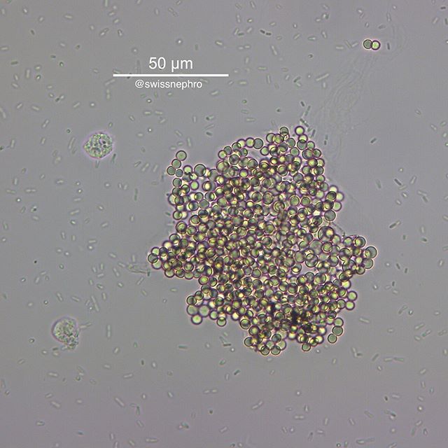 🔬Candida clump (with two leucocytes on the left and countless surrounding bacteria).
(Bright field, phase contrast, original magnification x400).
#urinarysediment #urine #nephrology #nephpearls #kidney #renal #FOAMed #medicine #microscope #laboratory #medstudent #pathology