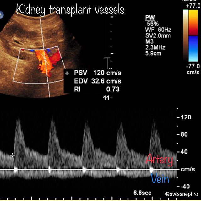 🦇Normal flow pattern in kidney transplant artery and vein.
#POCUS #NephPOCUS #IMPOCUS
#ultrasound #sonography #FOAMus #radiology #nephpearls #kidney #renal #FOAMed