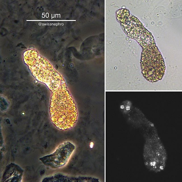 🔬Lipid cast in a patient with nephrotic proteinuria.
(Phase contrast, bright field, polarized light, original magnification x400)
#urinarysediment #urine #nephrology #nephpearls #kidney #renal #FOAMed #medicine #microscope #laboratory #medstudent #pathology