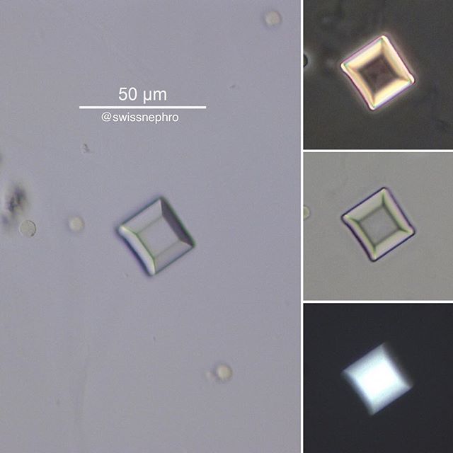 🔬Quadratic struvite crystal.
(PseudoDIC, phase contrast, bright field, polarized light, original magnification x400)
#urinarysediment #urine #nephrology #nephpearls #kidney #renal #FOAMed #medicine #microscope #laboratory #medstudent #pathology