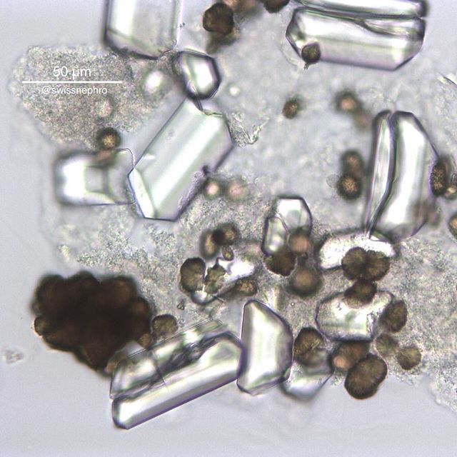🔬Crystals, current and from way back in 1872 by Ultzmann & Hofmann: Prisms of magnesium ammonium phosphate (Struvite) and spheres of ammonium hydrogen urate occurring together in alkaline urine.
#urinarysediment #urine #nephrology #nephpearls #kidney #renal #FOAMed #medicine #microscope #laboratory #medstudent #pathology