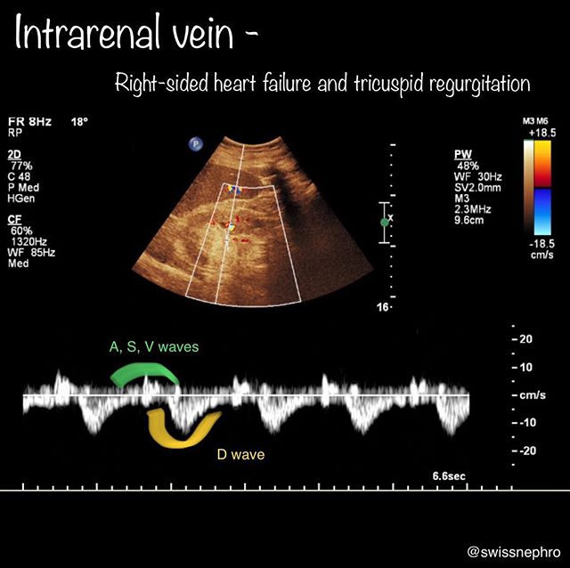 🦇“Arterialized“ intrarenal vein flow in right heart failure/tricuspid regurgitation (with corresponding hepatic and portal vein flow patterns. Associated w poor prognosis in CHF.
#POCUS #NephPOCUS #IMPOCUS
#ultrasound #sonography #FOAMus #radiology #nephpearls #kidney #renal #FOAMed