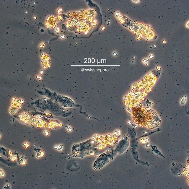 🔬Tubular epithelial cell casts in a patient with AKI 3.
(Phase contrast, original magnification x100)
#urinarysediment #urine #nephrology #nephpearls #kidney #renal #FOAMed #medicine #microscope #laboratory #medstudent #pathology
