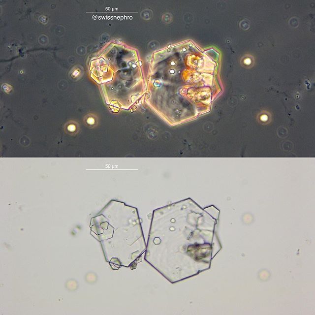 🔬Cystine crystals in a patient with #cystinuria.
(Phase contrast, bright field, original magnification x400)
#urinarysediment #urine #nephrology #nephpearls #kidney #renal #FOAMed #medicine #microscope #laboratory #medstudent #pathology