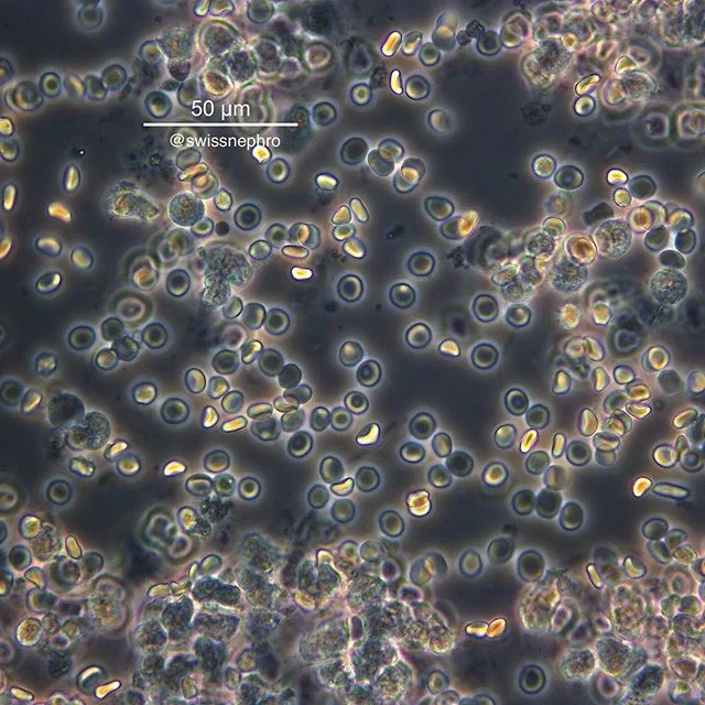 🔬Non-glomerular RBCs and some leucocytes in a patient with UTI.
(Phase contrast, original magnification x400)
#urinarysediment #urine #nephrology #nephpearls #kidney #renal #FOAMed #medicine #microscope #laboratory #medstudent #pathology