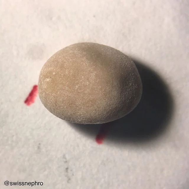 🔬Smooth kidney stone composed of 80% brushite (CaHydrogenphosphate dihydrate) and 20% whewellite (CaOxalate monohydrate).
#urine #nephrology #nephpearls #kidney #renal #FOAMed #medicine #nephrolithiasis #laboratory #medstudent #pathology #kidneystones