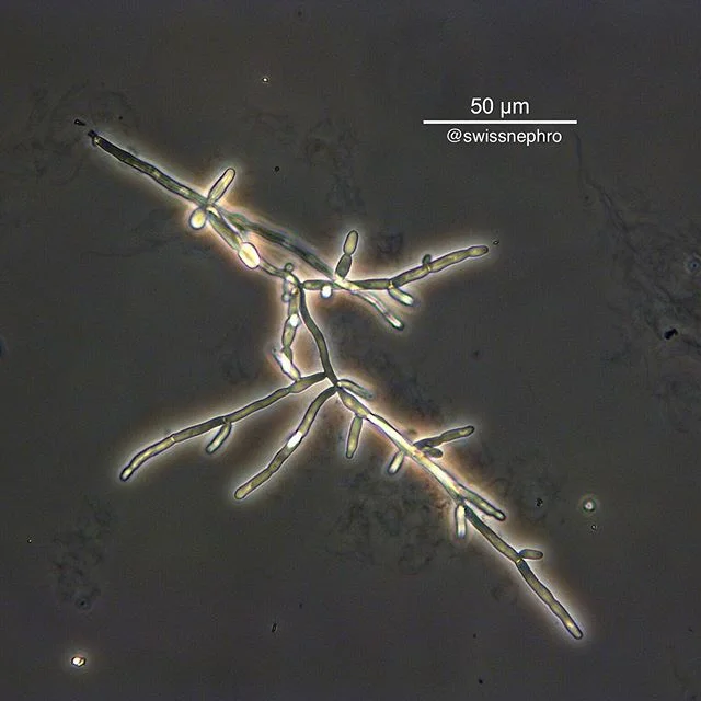🔬Pseudohyphae. Besides yeasts, another morphology of candida in the urine.
(Phase contrast, bright field, original magnification x400)
#urinarysediment #urine #nephrology #nephpearls #kidney #renal #FOAMed #medicine #microscope #laboratory #medstudent #pathology