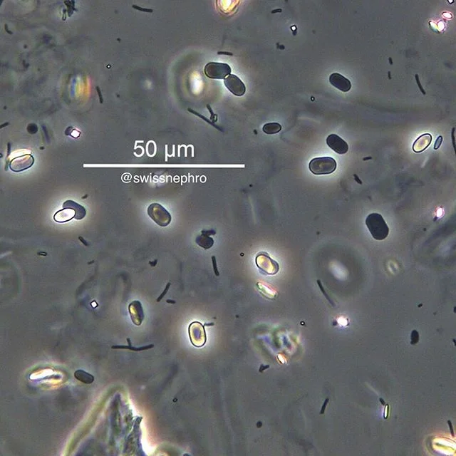 🔬Extensive CaOxalate monohydrate (COM) crystalluria in a patient with a gastric bypass.
Note strong birefringence under polarized light.
(Phase contrast, polarized light, original magnification x400)
#urinarysediment #urine #nephrology #nephpearls #kidney #renal #FOAMed #medicine #microscope #laboratory #medstudent #pathology