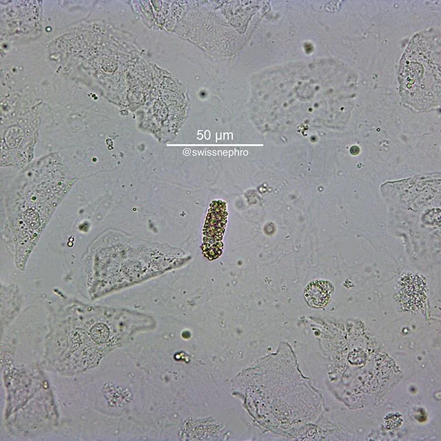 🔬Tiny lipid cast among squamous epithelial cells.
(Bright field, original magnification x400)
#urinarysediment #urine #nephrology #nephpearls #kidney #renal #FOAMed #medicine #microscope #laboratory #medstudent #pathology