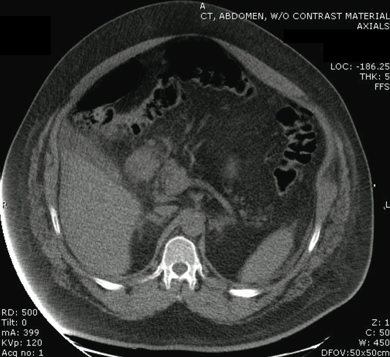 CT ACCS wiki 1 chest pain.jpg