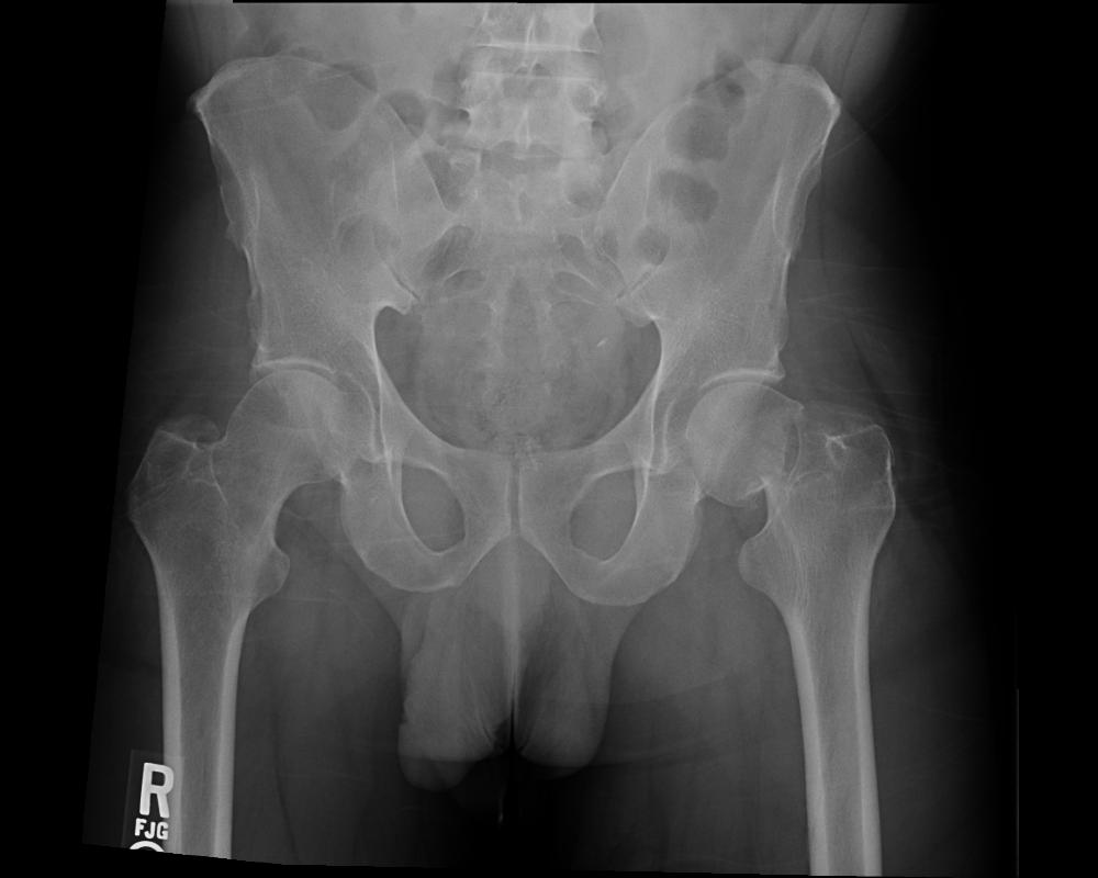 ACCS Hip X-ray.jpg