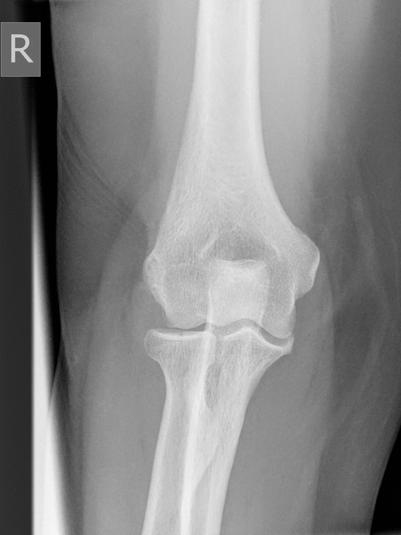 Broken Knee X Ray Joke