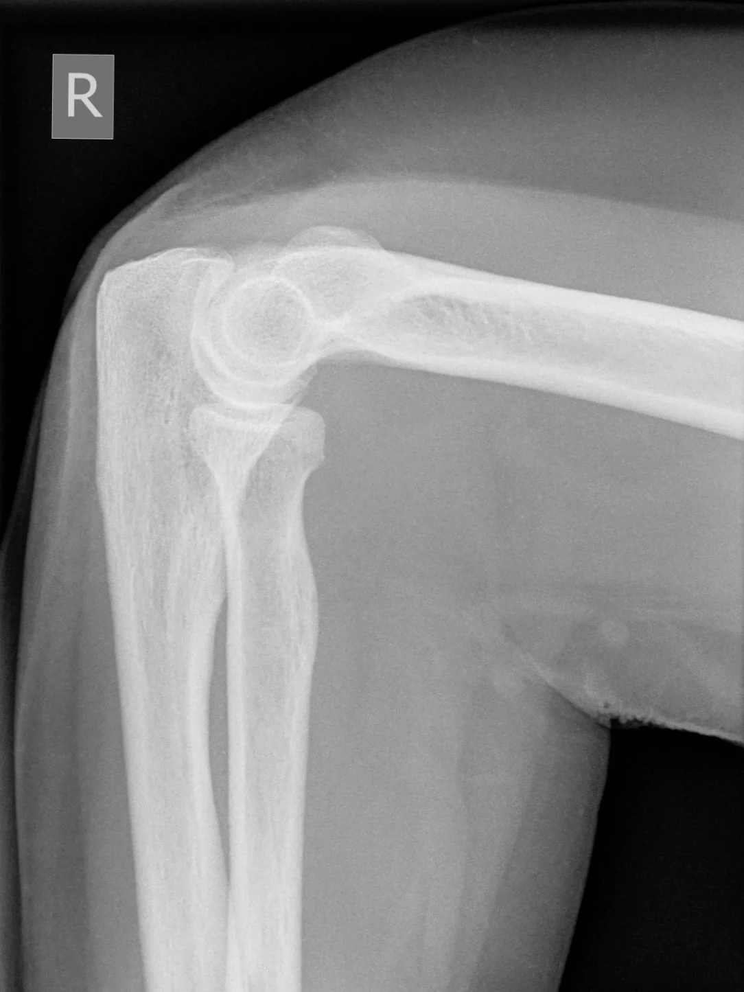 Knee x-ray 1 (miniteach).jpg
