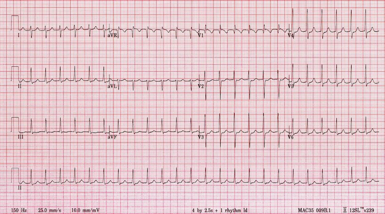 #SimBlog: Modified Valsalva Manoeuvre (SVT) — EM3