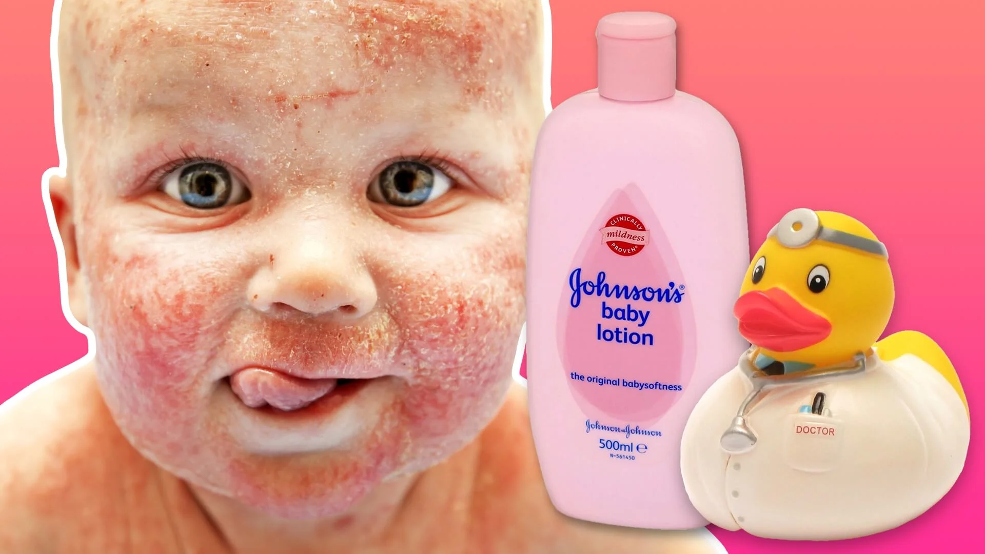 Eczema Management in Paeds ED — EM3