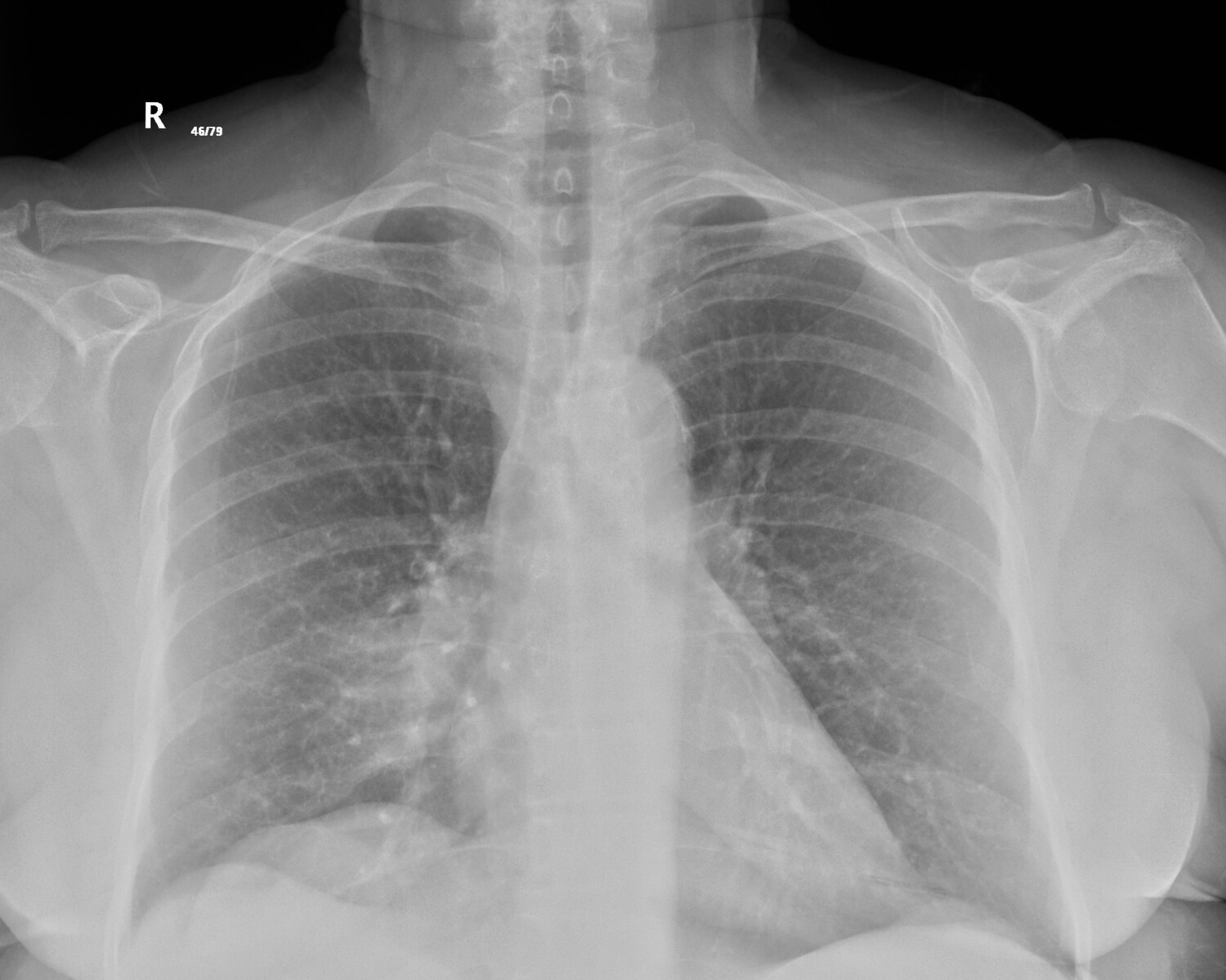 Lung X-ray (miniteach).jpeg