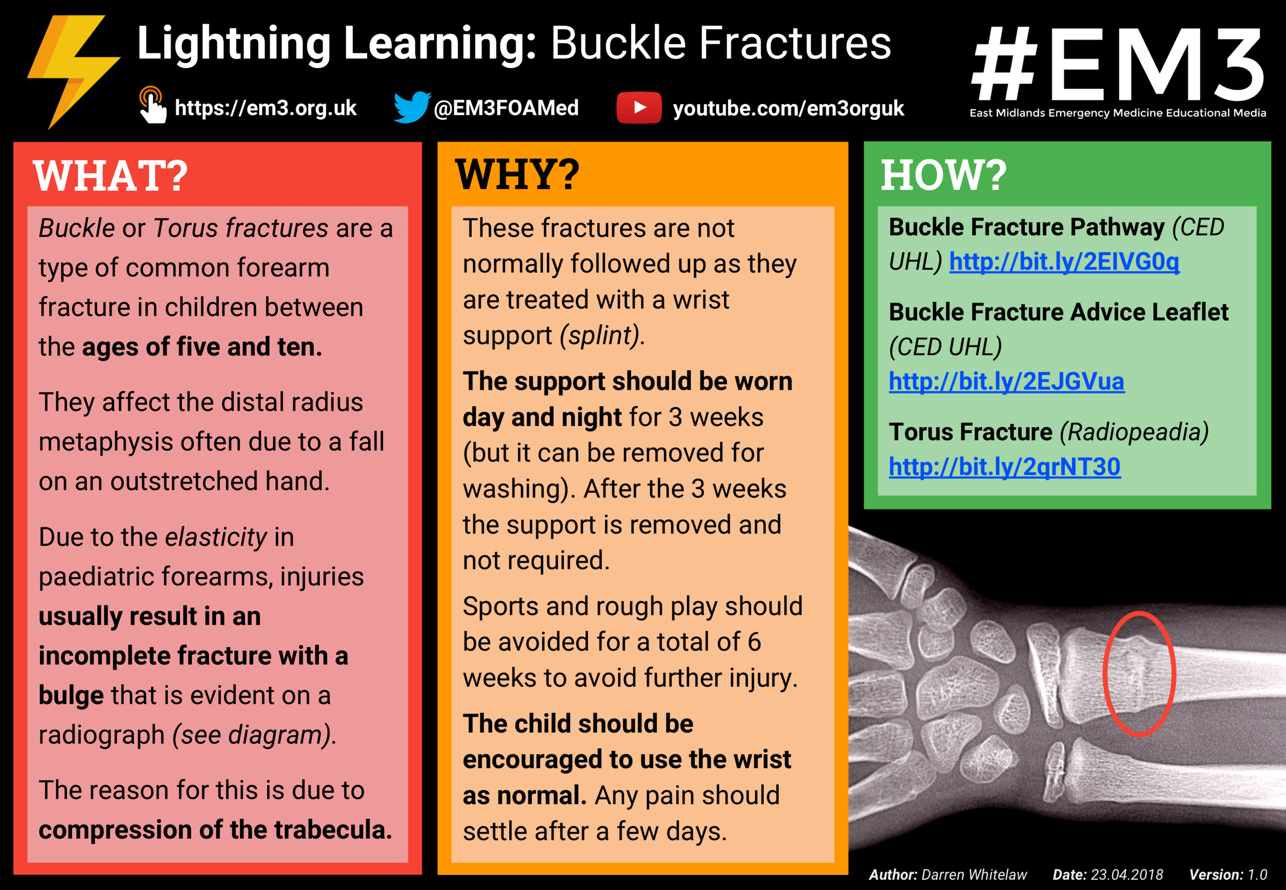 Lightning Learning - Buckle Fractures.png