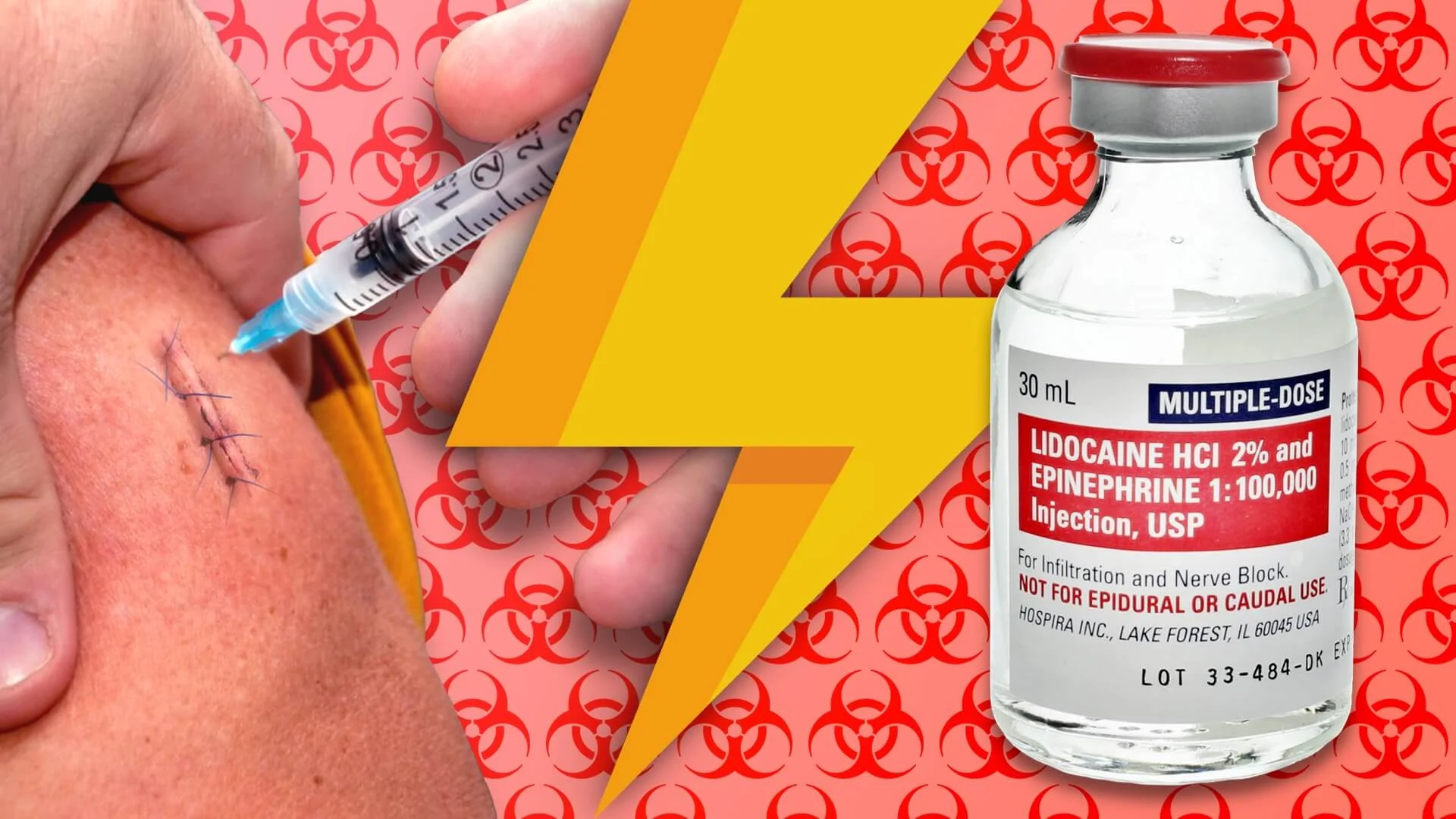 DENTAL ANESTHESIA Dose Calculation Of Lidocaine And, 55 OFF