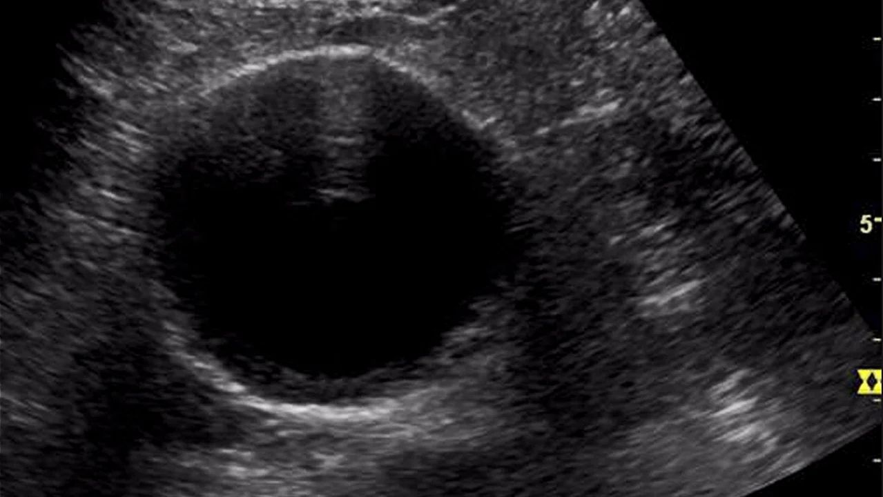 #SimBlog: Ruptured AAA