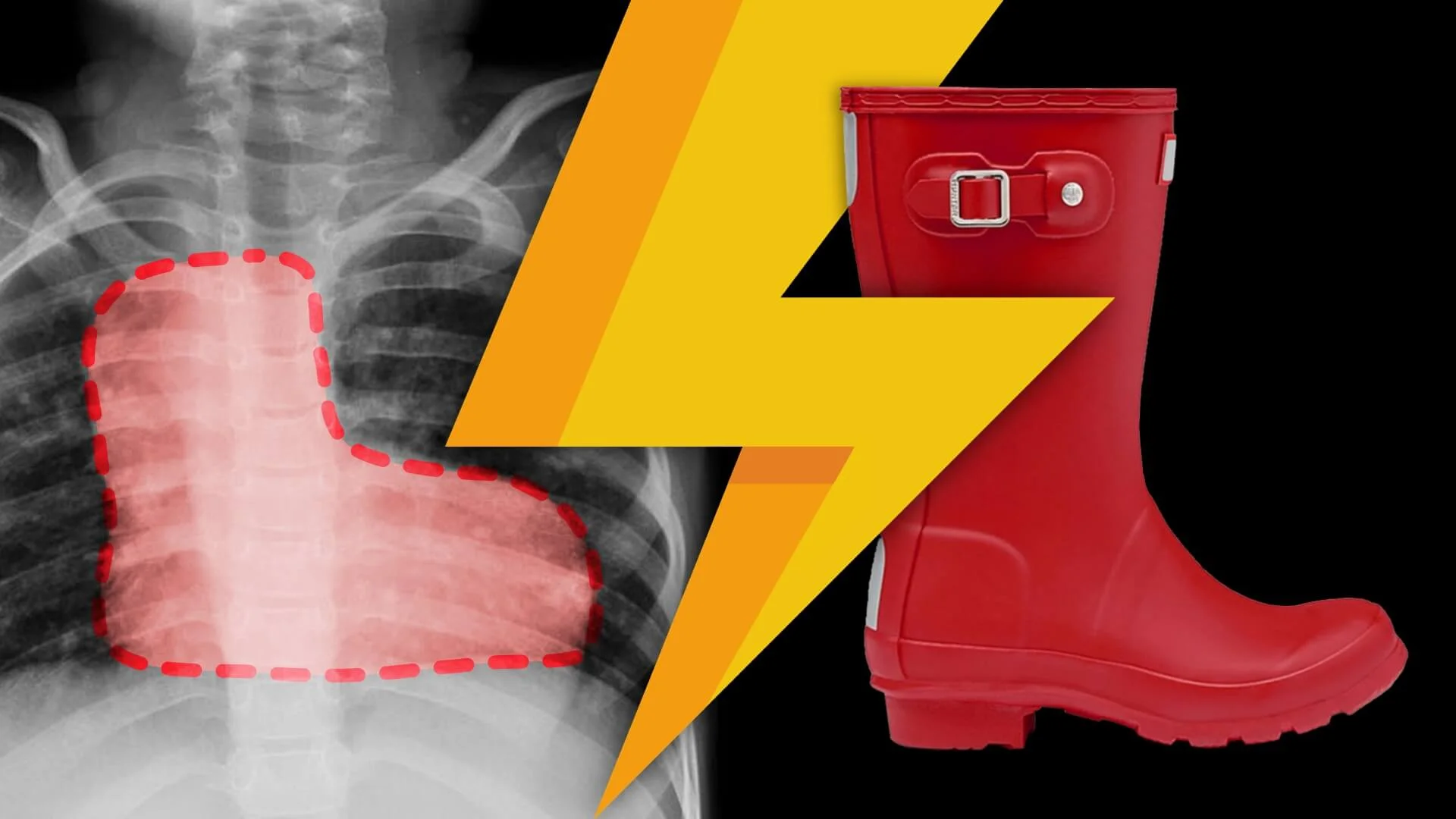 Tips On Understanding Fallouts Lightning Learning: Tetralogy of Fallot — EM3