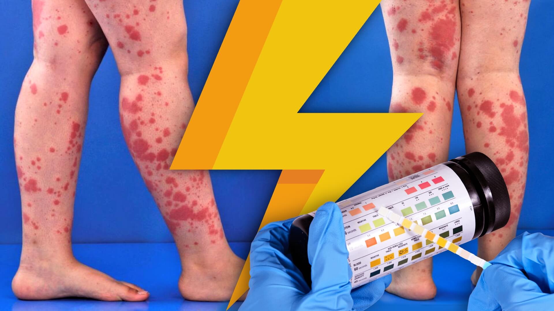 PAP4: Blood Disorders — #EM3: East Midlands Emergency Medicine ...