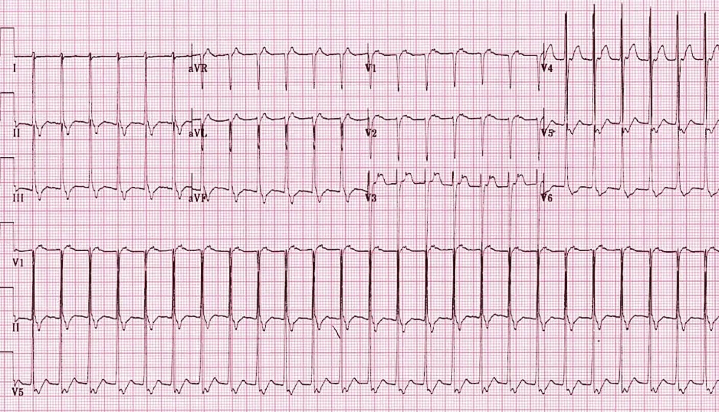 Avrt Ecg Example #SimBlog: Facing Your Demons — EM3