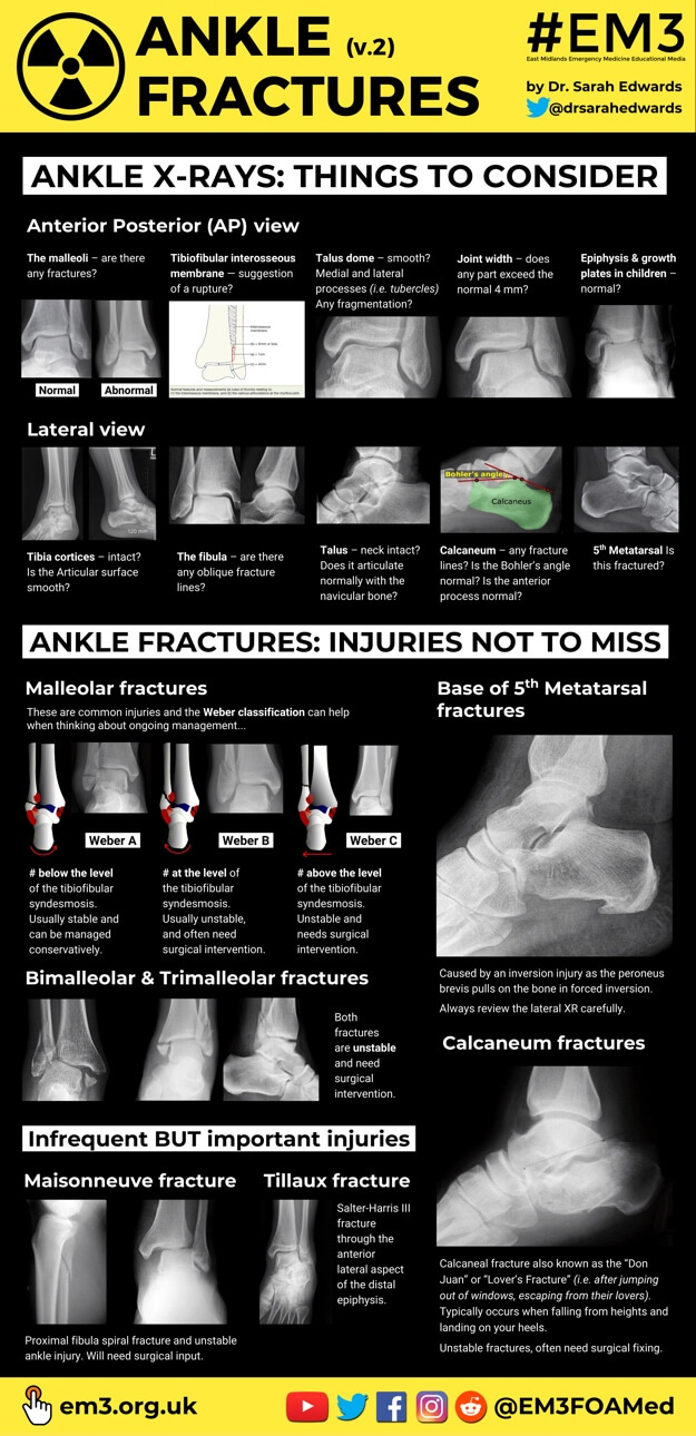 Ankle Fractures v.2 (thumbnail).jpg