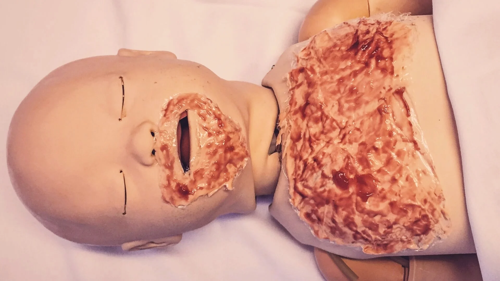 #SimBlog: Scalded Child