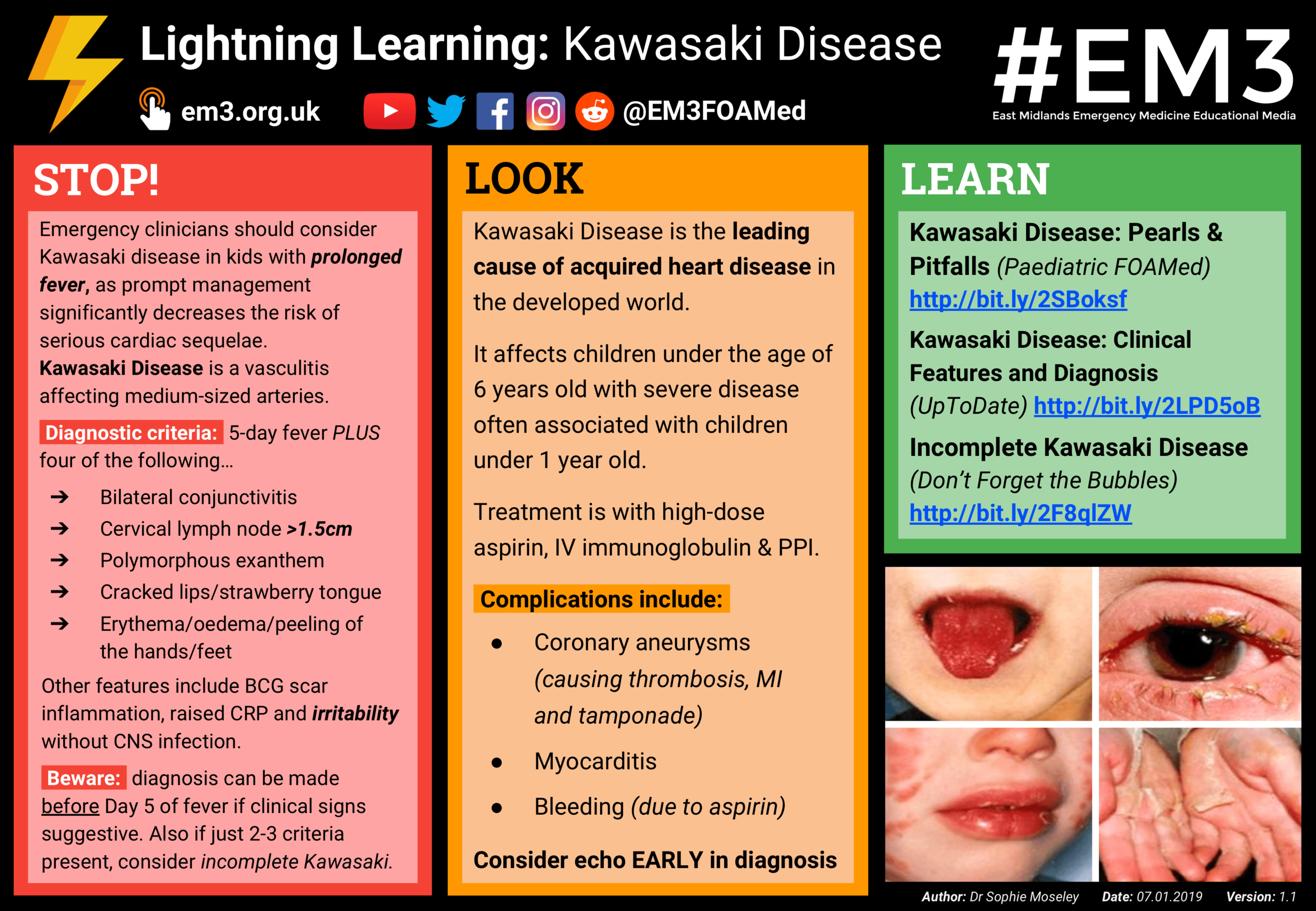 Lightning Learning: Kawasaki Disease #EM3: Midlands Emergency Medicine Educational Media