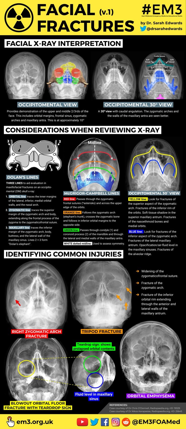 Facial Fractures poster - Dr Sarah Edwards (thumbnail).jpg