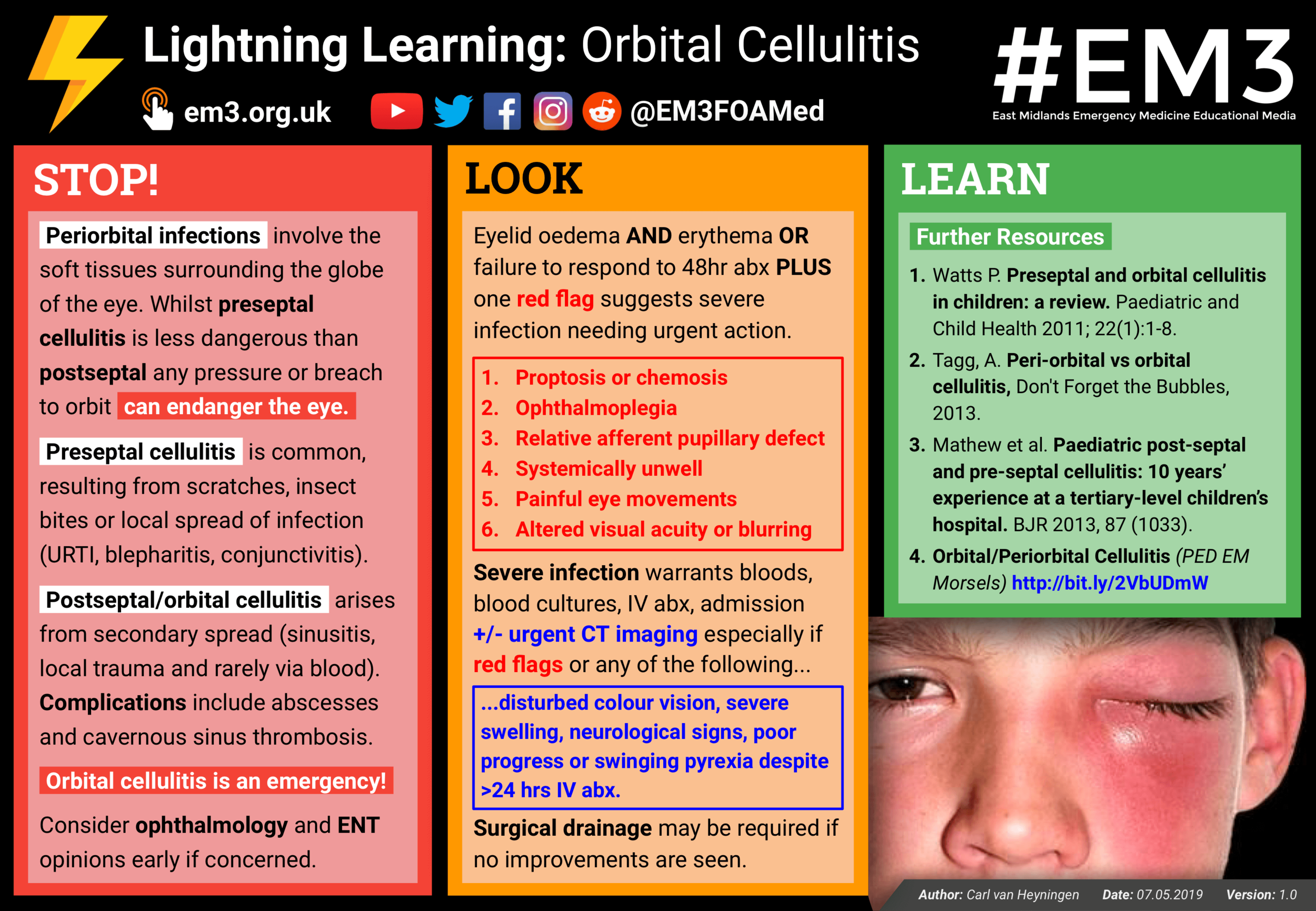 Lightning Learning Orbital Cellulitis — EM3
