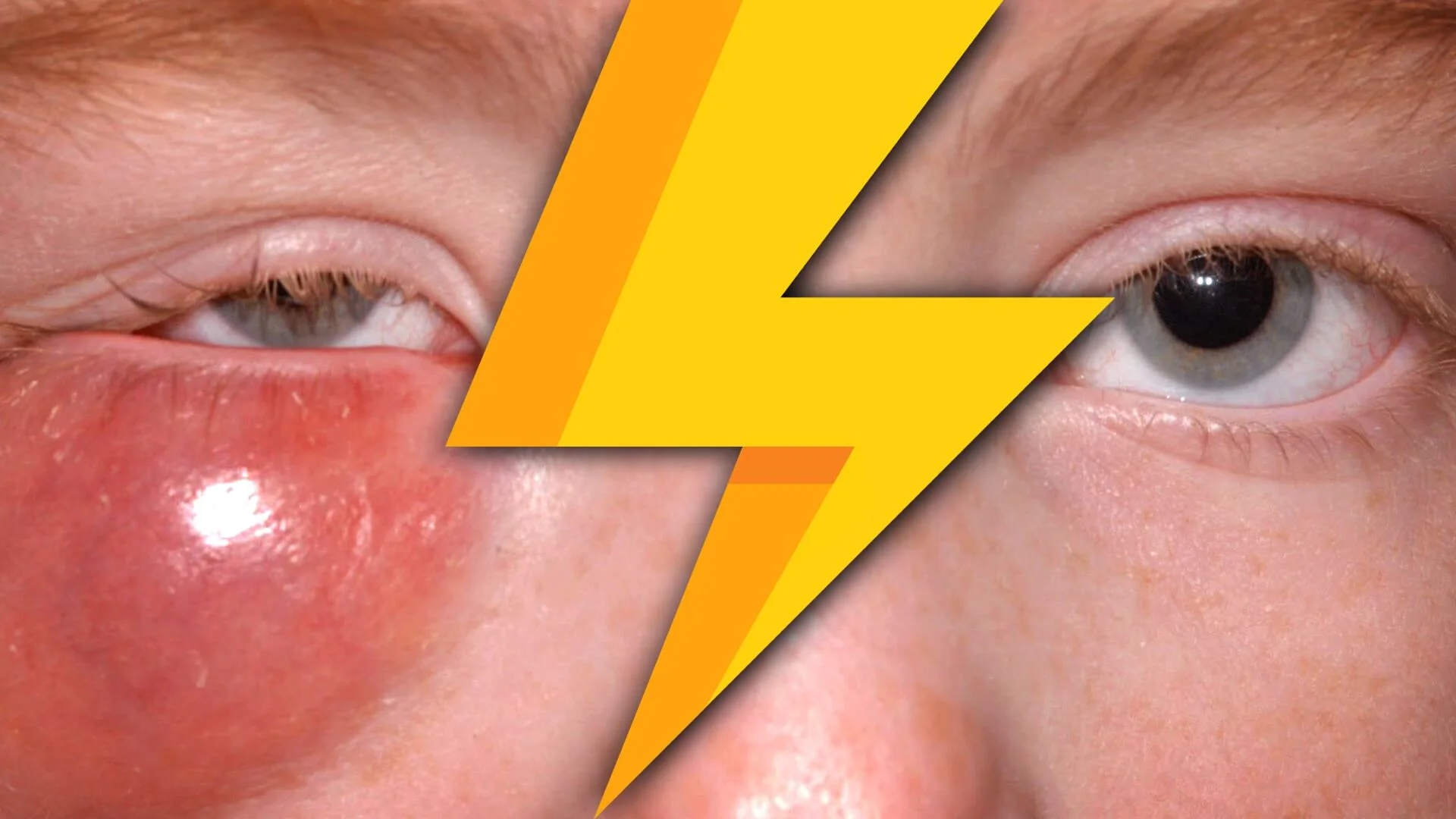 Orbital Cellulitis