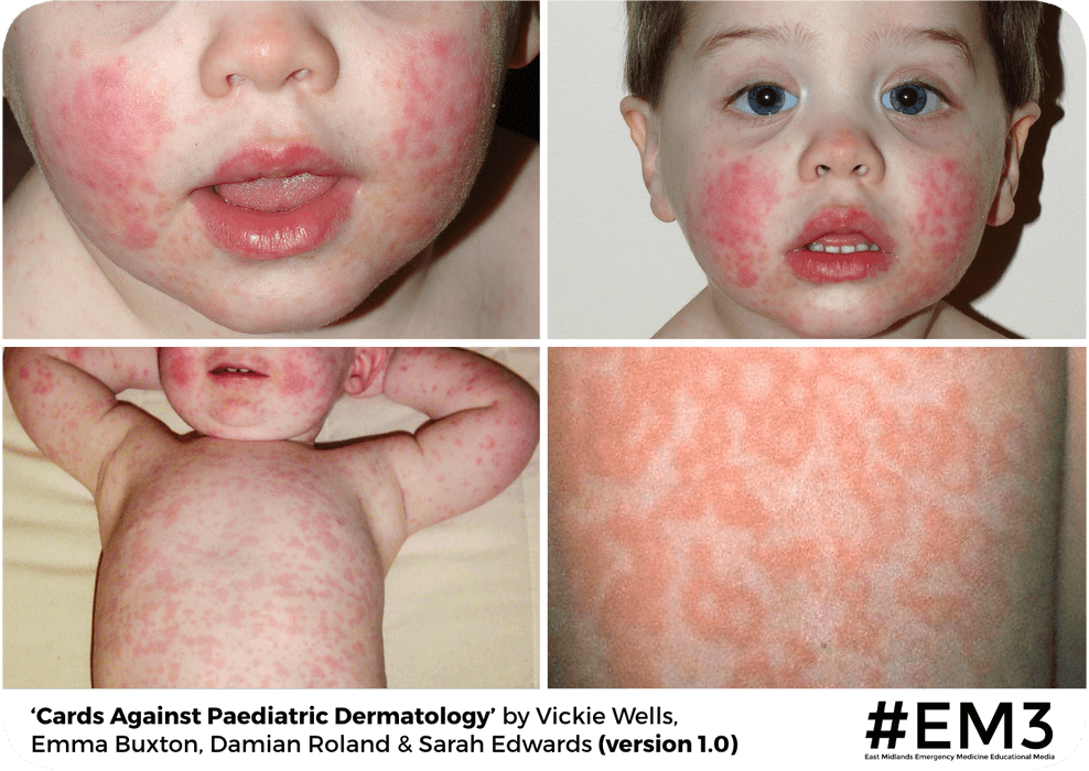 Cards Against Paediatric Dermatology — EM3