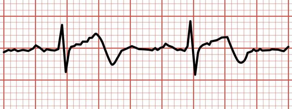 Lightning Learning: Wellens Syndrome — #EM3: East Midlands Emergency ...
