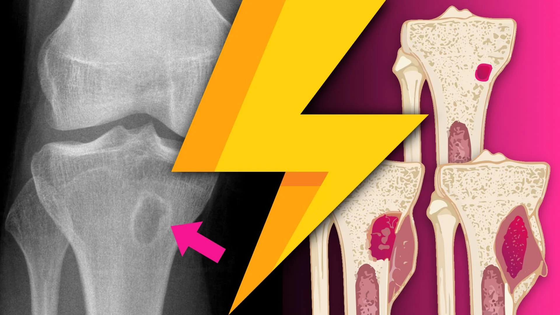 Lightning Learning: Osteomyelitis in Kids