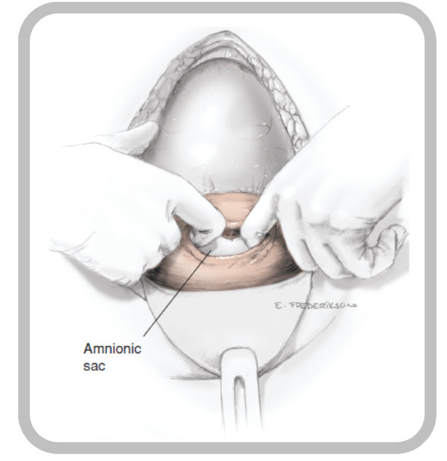 C-section technique 2 (Resus Drill #3).png