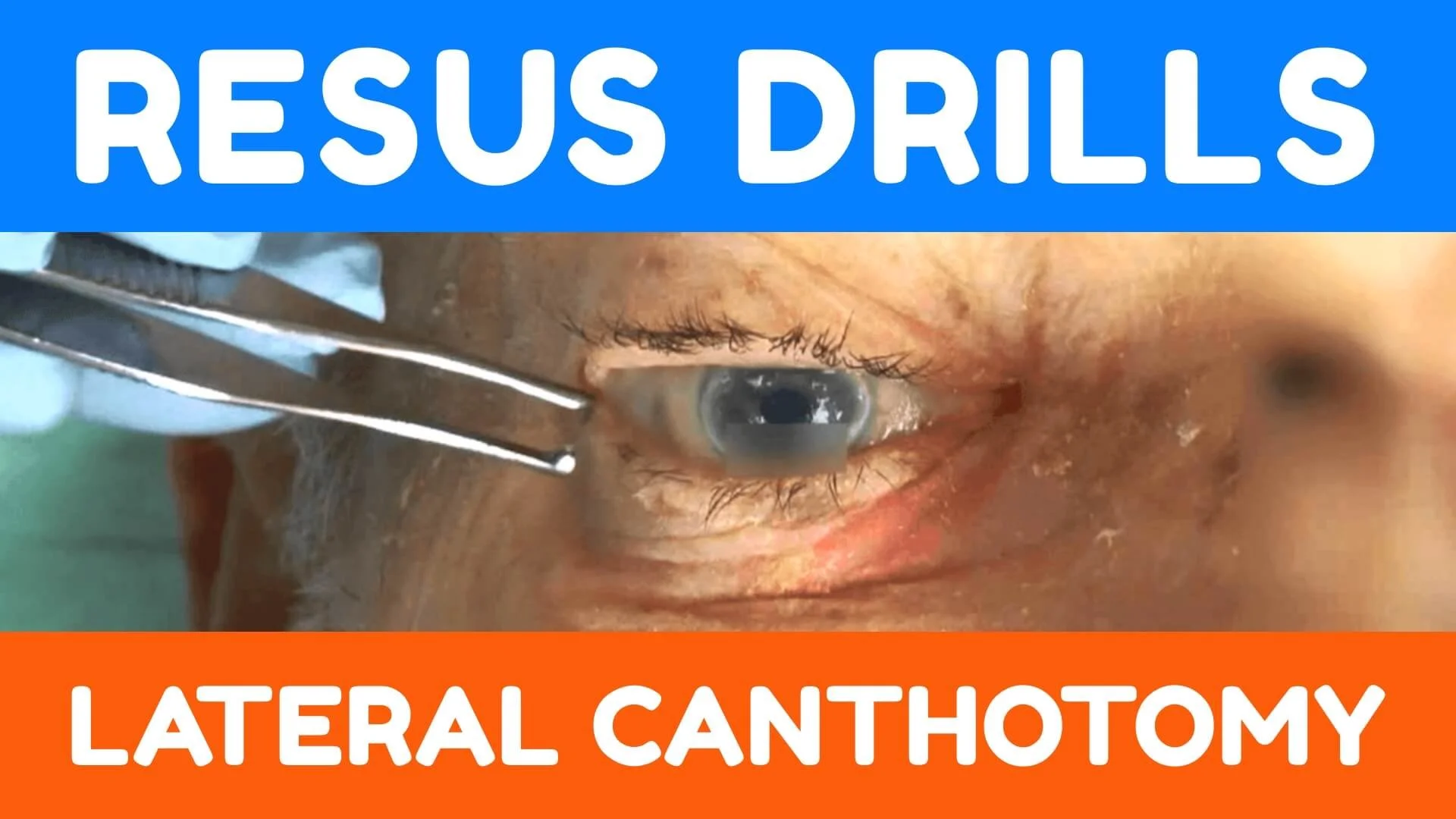 Resus Drills: Lateral Canthotomy — EM3
